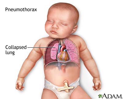Pneumothorax Pneumothorax