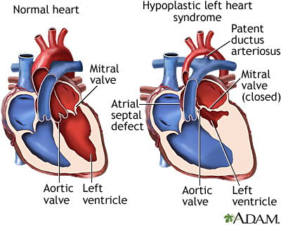 Hypoplastic left heart syndrome Hypoplastic left heart syndrome
