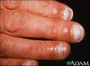 Scurvy - periungual hemorrhage Scurvy - periungual hemorrhage