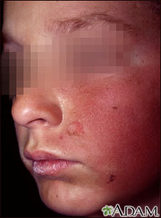 Dermatitis - contact on the cheek Dermatitis - contact on the cheek