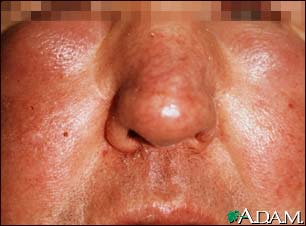Edema - central on the face Edema - central on the face