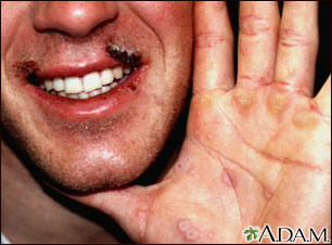 Erythema multiforme on the hand Erythema multiforme on the hand