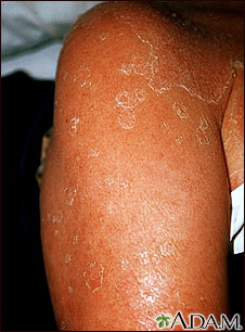 Exfoliation following erythroderma Exfoliation following erythroderma