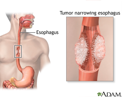 Esophageal cancer
