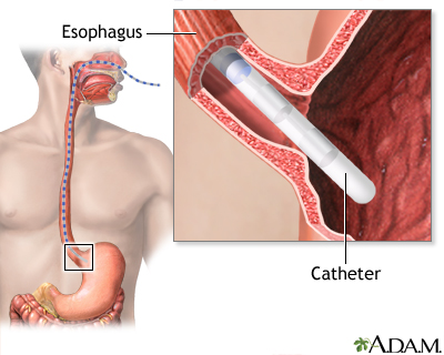 Esophageal manometry test Esophageal manometry test
