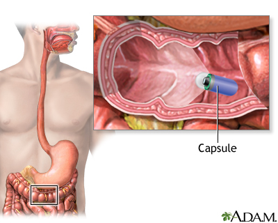 Capsule endoscopy Capsule endoscopy