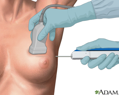 Core needle biopsy of the breast Core needle biopsy of the breast