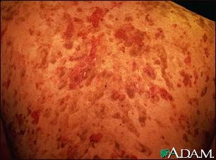 Pemphigus vulgaris on the back Pemphigus vulgaris on the back