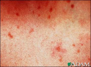 Urticaria pigmentosa - close-up Urticaria pigmentosa - close-up