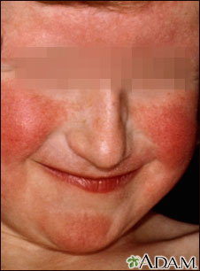 Dermatitis - atopic on a young girl's face Dermatitis - atopic on a young girl's face