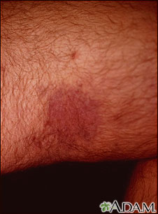 Kaposi sarcoma on the thigh