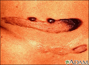 Keloid - pigmented Keloid - pigmented