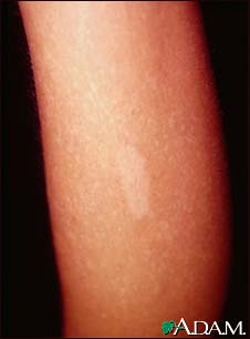 Tuberous sclerosis - hypopigmented macule