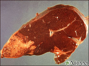 Hodgkin's disease - liver involvement Hodgkin's disease - liver involvement