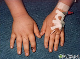 Snake bite on the finger Snake bite on the finger