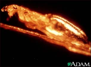 Head louse emerging from egg Head louse emerging from egg