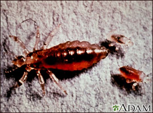 Body louse, female and larvae Body louse, female and larvae