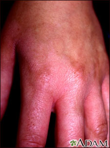Photocontact dermatitis on the hand