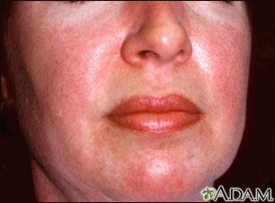 Dermatomyositis - heliotrope rash on the face Dermatomyositis - heliotrope rash on the face