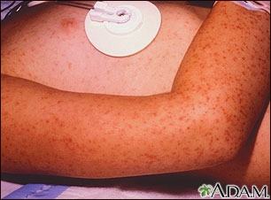 Rocky mountain spotted fever - petechial rash Rocky mountain spotted fever - petechial rash