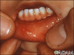 Hand, foot, and mouth disease - mouth Hand, foot, and mouth disease - mouth