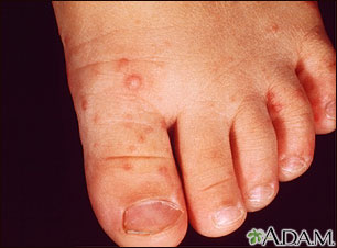 Hand, foot, and mouth disease on the foot Hand, foot, and mouth disease on the foot