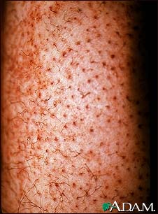 Scurvy - corkscrew hairs