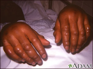 Frostbite - hands Frostbite - hands