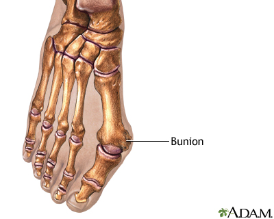 Indications Indications