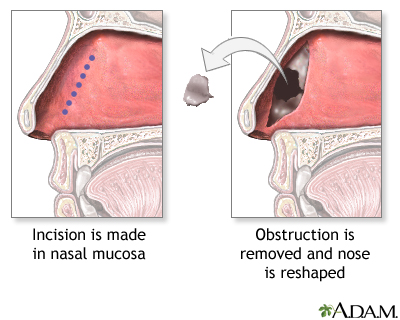 Procedure - Septoplasty Procedure - Septoplasty