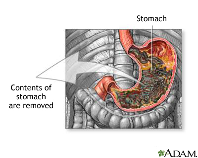 Gastric suction Gastric suction