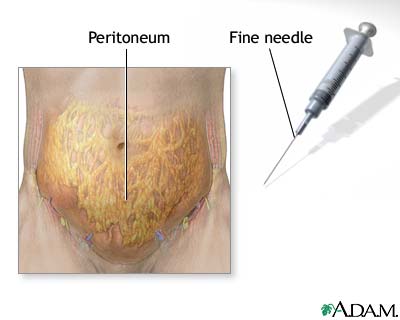Peritoneal fluid sampling Peritoneal fluid sampling