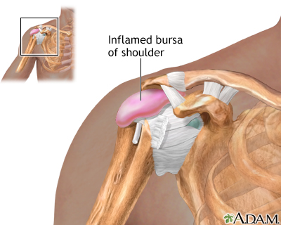 Bursitis of the shoulder Bursitis of the shoulder