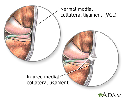 Torn medial collateral ligament Torn medial collateral ligament