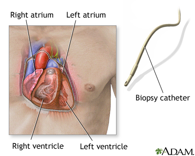 Biopsy catheter Biopsy catheter