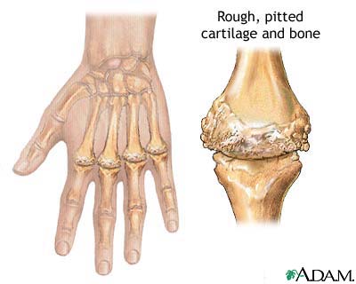 Rheumatoid arthritis Rheumatoid arthritis
