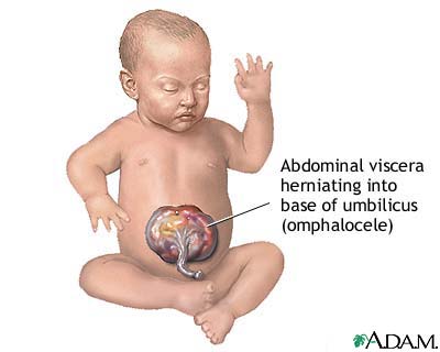 Infant omphalocele Infant omphalocele