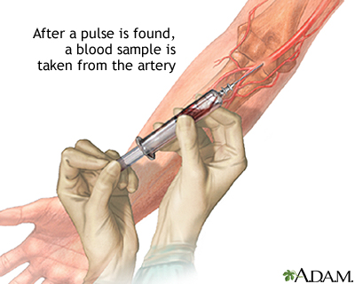 Arterial blood sample Arterial blood sample