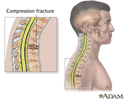 Compression fracture Compression fracture