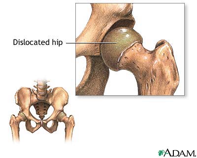 Congential hip dislocation Congential hip dislocation