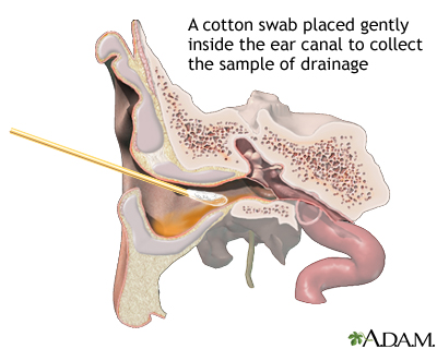 Ear drainage culture Ear drainage culture