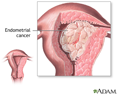 Endometrial cancer Endometrial cancer