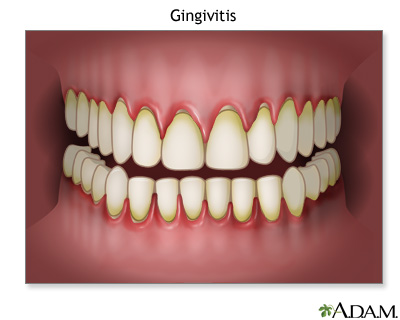 Gingivitis Gingivitis