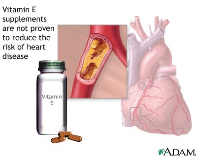 Vitamin E and heart disease Vitamin E and heart disease