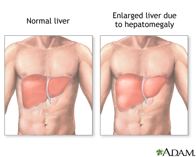 Hepatomegaly Hepatomegaly