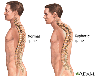Kyphosis Kyphosis