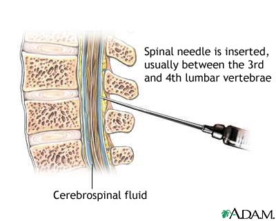 Lumbar puncture Lumbar puncture