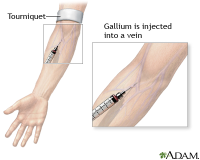 Gallium injection Gallium injection