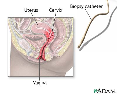Endometrial biopsy Endometrial biopsy