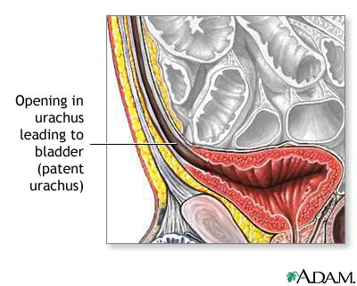 Patent urachus Patent urachus